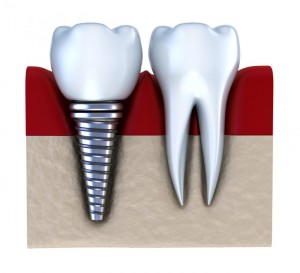 dental implant Charlottesville