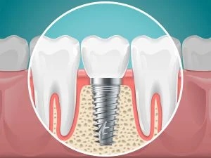 implant dentist Charlottesville